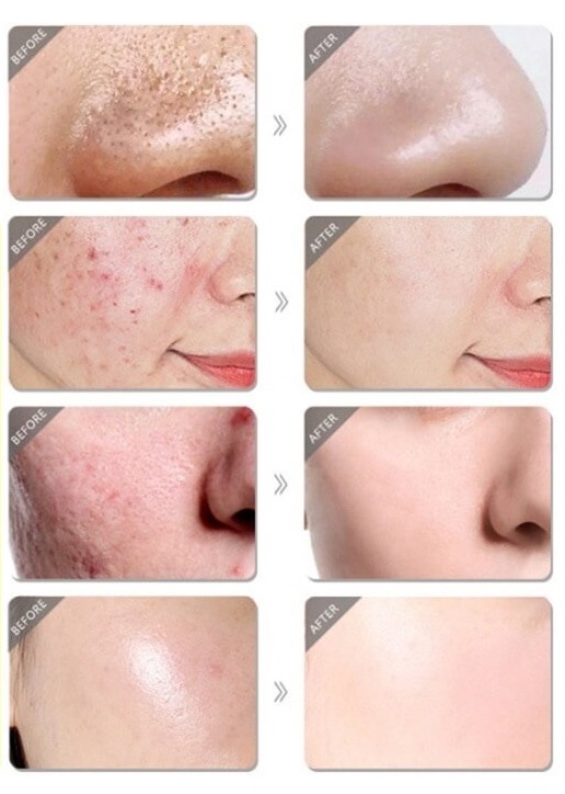 The effect of BPO cream on the skin